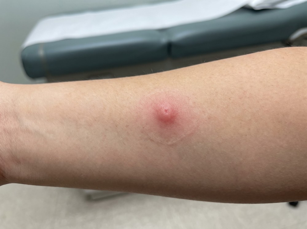 Close-up photo of a fresh water bug bite on a toe showing a single small red puncture mark with mild surrounding swelling